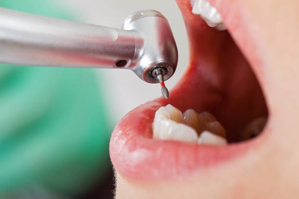 Best Dental Abscess Treatment in Rosend, LA